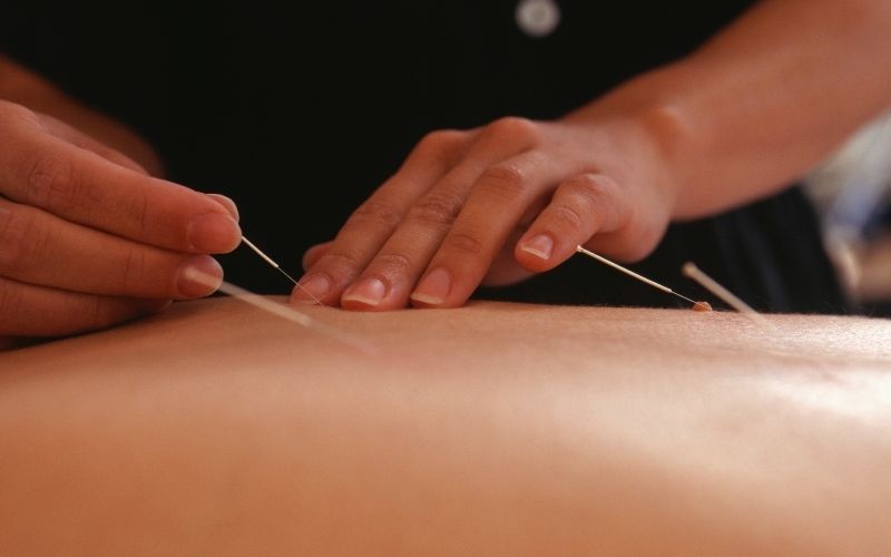 acupuncture needles in back